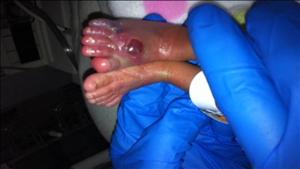 Newborn Kendall Shaw's Injured Foot from News10/KXTV